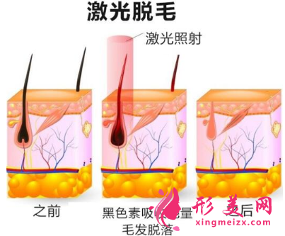 激光脫毛費(fèi)用多少