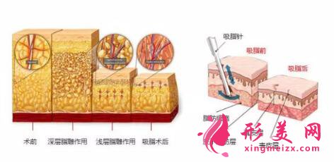 面部吸脂需要多少錢?