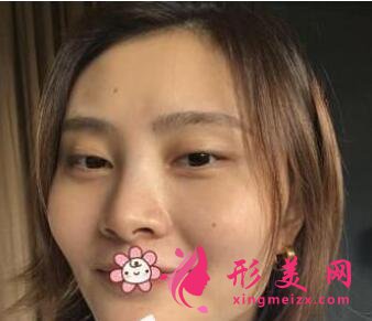 面部吸脂需要多少錢?