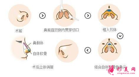 鼻尖手術(shù)多少錢?