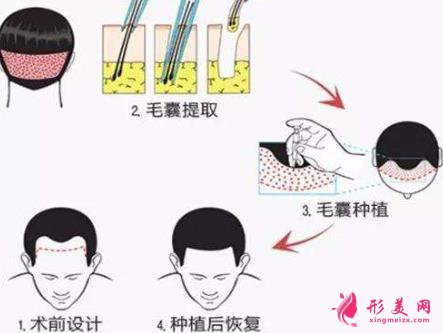 種植頭發(fā)的價(jià)格表更新發(fā)布，附上種植頭發(fā)案例！