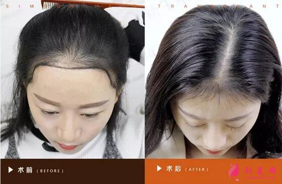 種植頭發(fā)哪里好？