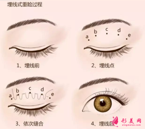 雙眼皮埋線后多久恢復(fù)自然