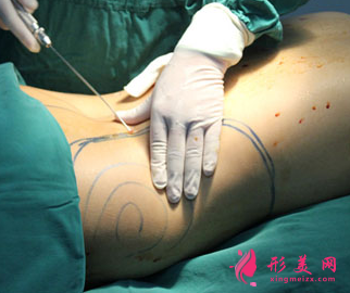 吸脂減肥會(huì)有血腫嗎