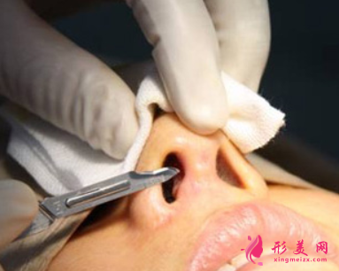 隆鼻假體取出后會(huì)有什么問題嗎