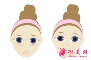 武漢抽脂法去眼袋的優(yōu)勢