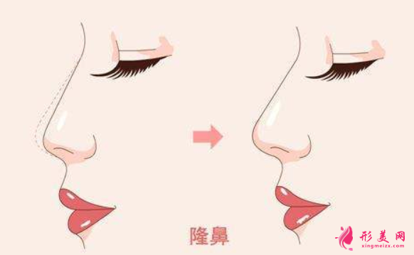 硅膠假體隆鼻能保持多少年