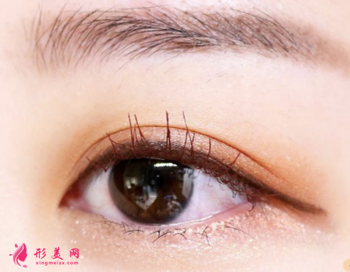 開內(nèi)眼角效果不理想怎么辦