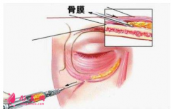 淚溝填充價格是多少？填充效果怎么樣？