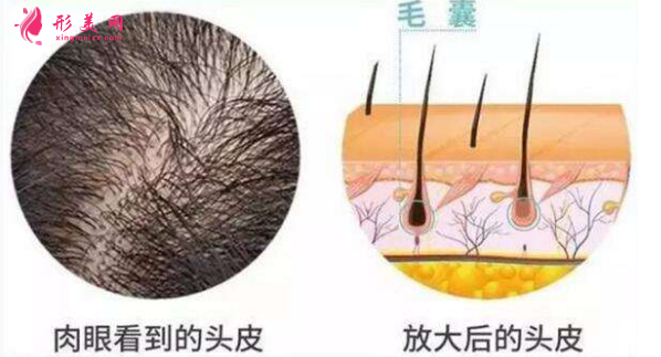 種植頭發(fā)需要多少錢