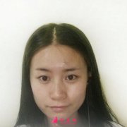 上海九院開眼角加雙眼皮體驗公開反饋,真人案例分享