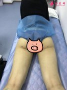 深圳鵬愛整形醫(yī)院大腿吸脂術案例反饋+整形美容價格表