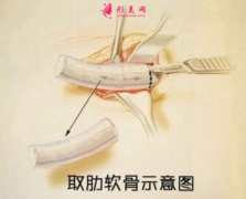 當代醫(yī)學美容醫(yī)院自體肋軟骨隆鼻怎么樣？有什么后遺癥嗎
