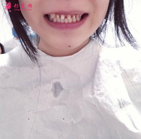 廣州德倫口腔牙齒整形體驗 牙齒這一家人就應(yīng)該整整齊齊的
