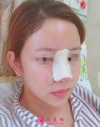 上海九院整形隆鼻怎么樣？鼻子做假體已經(jīng)5個月了，姐妹們幫我看