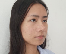 北京同仁醫(yī)院做瘦臉針，輕松擁有小V臉