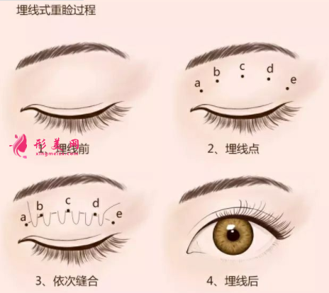 埋線(xiàn)雙眼皮后會(huì)脫線(xiàn)嗎