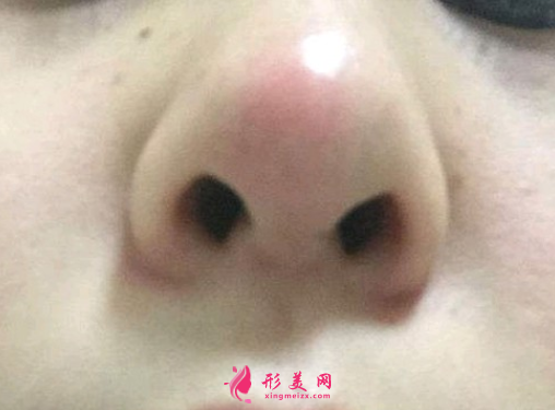 假體隆鼻失敗修復(fù)多少錢
