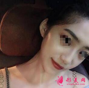 隆鼻經(jīng)驗(yàn)分享貼