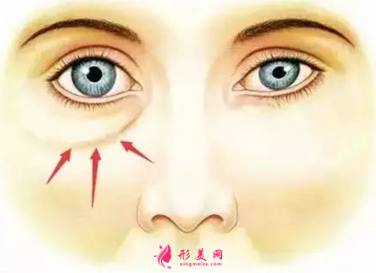 手術(shù)祛眼袋恢復(fù)期要多久