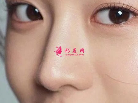 假體在鼻部內(nèi)放久了要更換嗎