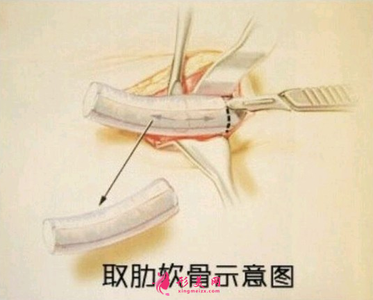 肋軟骨隆鼻后多久恢復(fù)正常