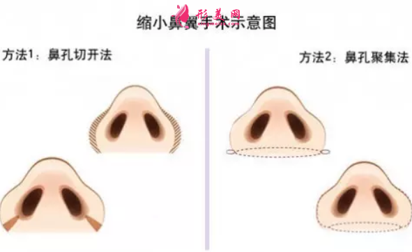 廣州鼻翼縮小手術(shù)安全嗎