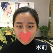 北京魏志香雙眼皮修復(fù)：魏志香醫(yī)生雙眼皮修復(fù)案例反饋！