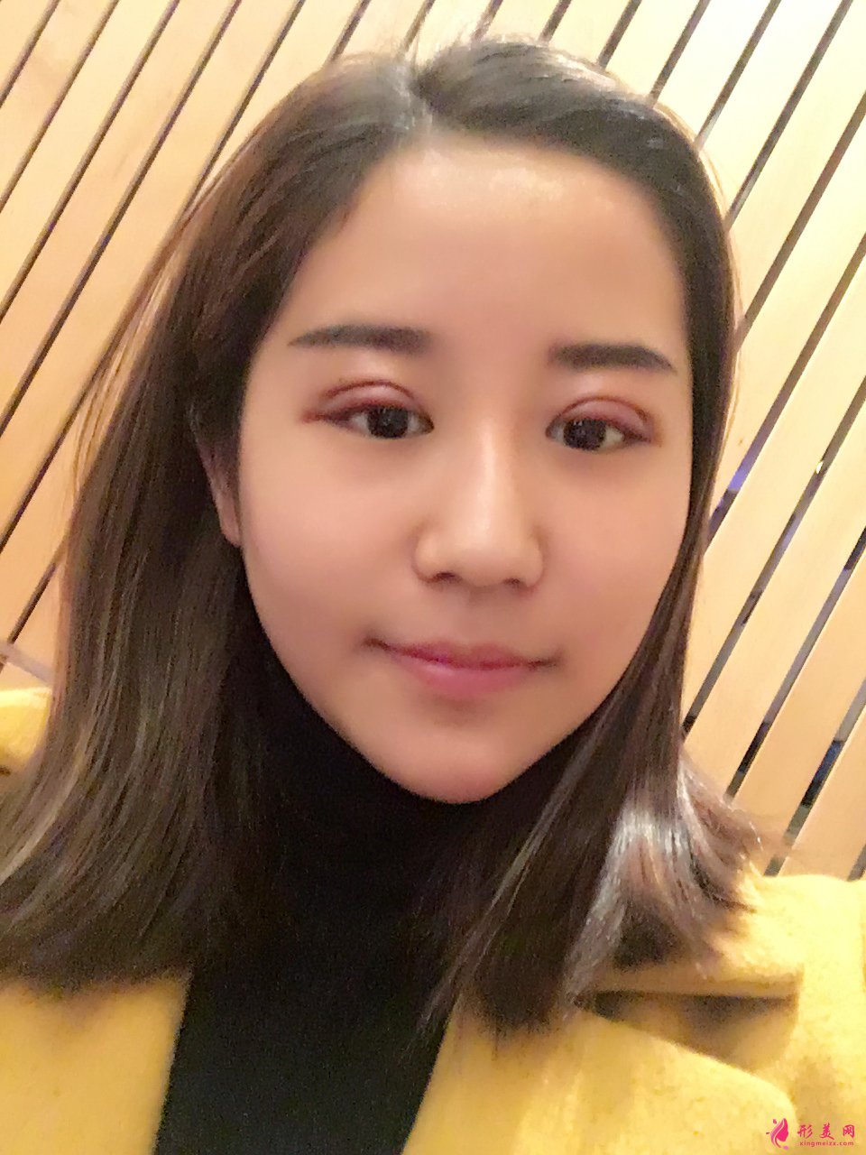 北京雙眼皮修復(fù)：魏志香醫(yī)生