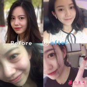 內(nèi)切去眼袋手術(shù)圖片，真實(shí)效果大家眼見為實(shí)！