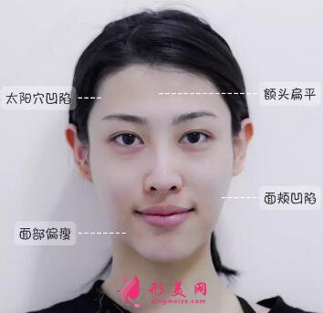 自體脂肪可以填充的部位