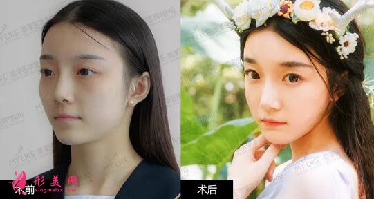 自體脂肪填充安全嗎