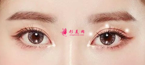 雙眼皮.png