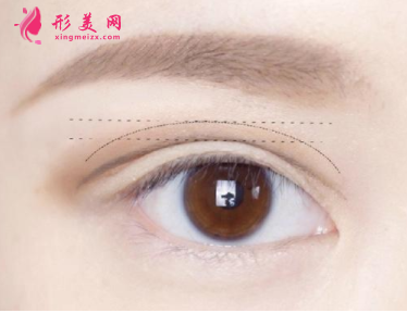 切開雙眼皮.png