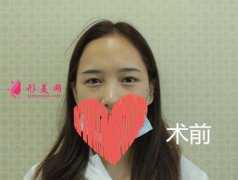 深圳赫思醫(yī)療美容怎么樣？整形美容價(jià)目表及隆鼻整形案例