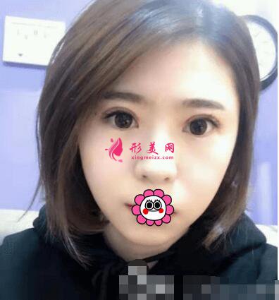 北京協(xié)和醫(yī)院整形外科雙眼皮術(shù)后效果圖，附整形美容價(jià)格表