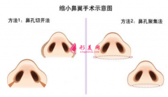 鼻翼縮小一般需要多少錢？