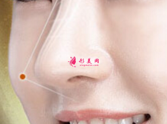 假體隆鼻安不安全