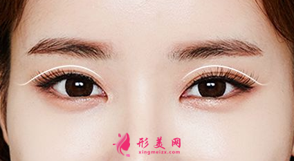 雙眼皮術(shù)后要注意的問(wèn)題.png