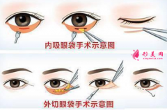 怎么降低手術(shù)祛眼袋的風(fēng)險(xiǎn)？