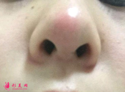隆鼻失敗.png