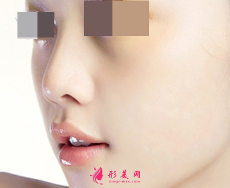 隆鼻失敗修復(fù) (2).png