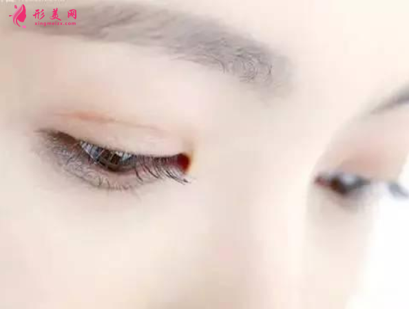 雙眼皮術(shù)后.png