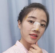 哈爾濱醫(yī)大二院美容科隆鼻效果咋樣?附隆鼻術(shù)后案例