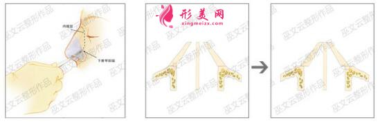 截骨內(nèi)推示意圖