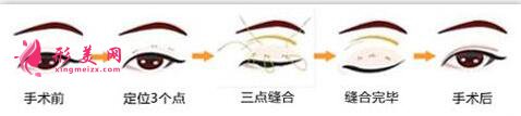 韓式三點式雙眼皮的效果