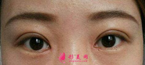 韓式三點式雙眼皮適合的人群