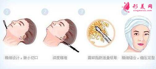 面頰部吸脂方法