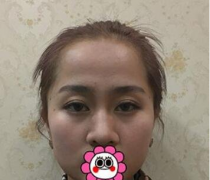 上海首爾麗格做鼻綜合怎么樣？附2020整形美容價(jià)格表+案例展示