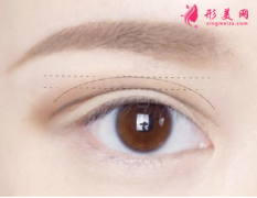 全切雙眼皮費用需要多少？